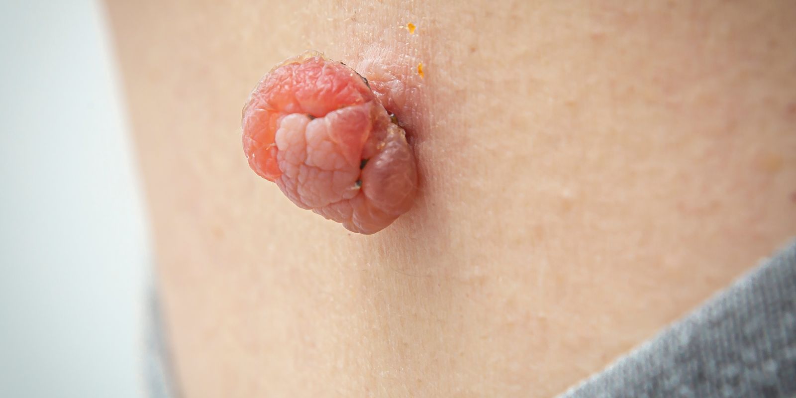 הסרת סרחי עור